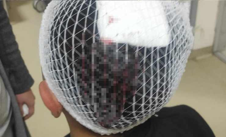 Çorum'da şampiyonluk kutlamasında atılan havai fişek küçük çocuğun başına isabet etti