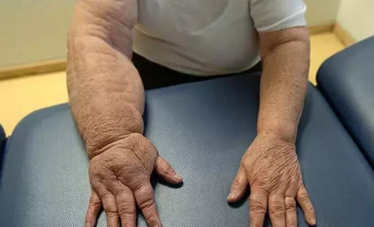 Fil hastalığı nedir, tedavisi var mı?