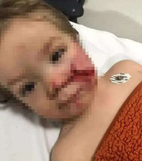 Etimesgut'ta pitbull saldırısına uğrayan 1.5 yaşındaki çocuk da taburcu oldu